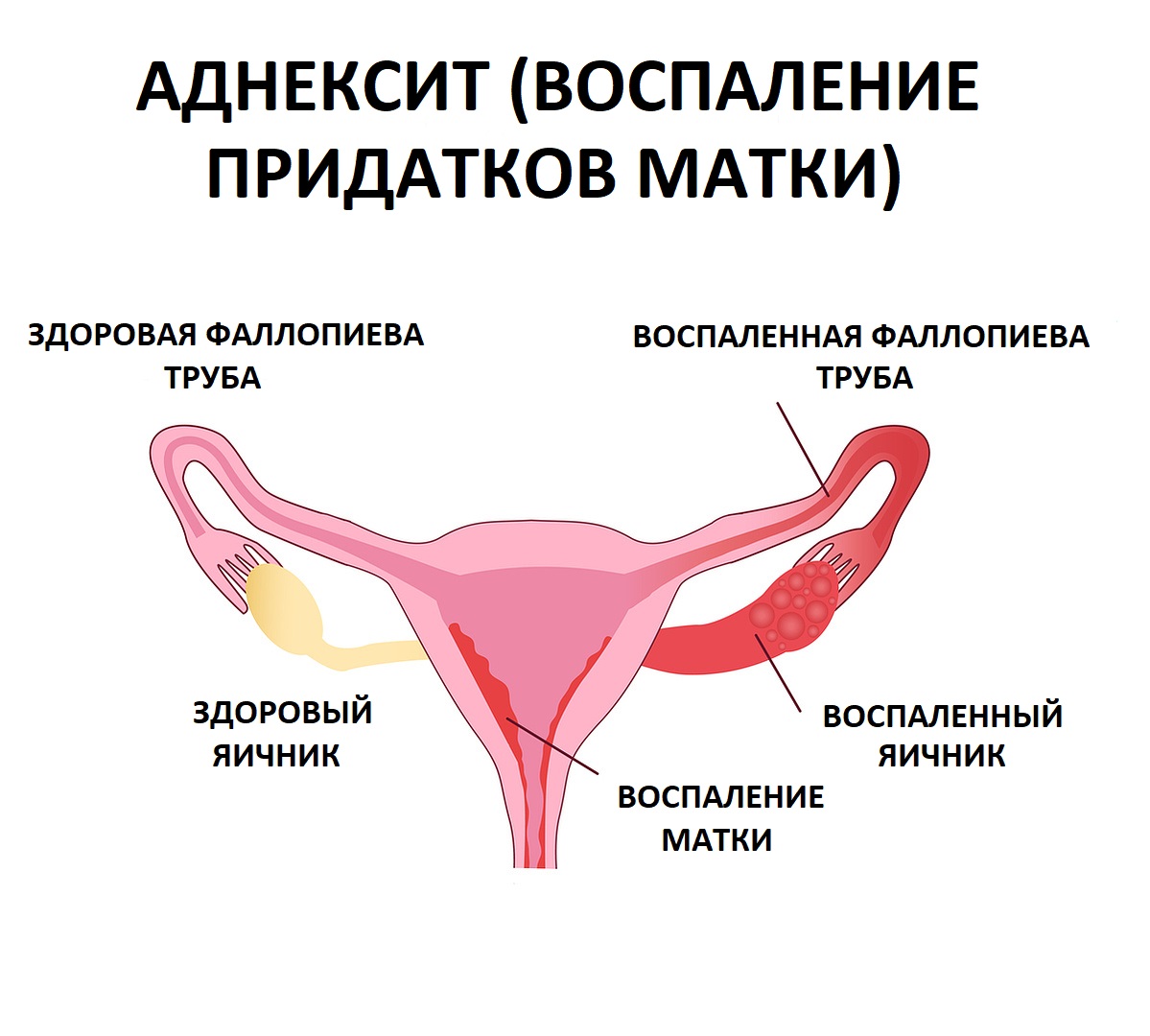 Лечение хронического и острого аднексита (воспаления придатков матки)