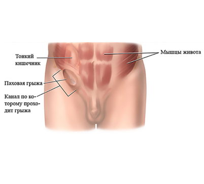 Симфизит у беременных! Что делать? Как рожать?