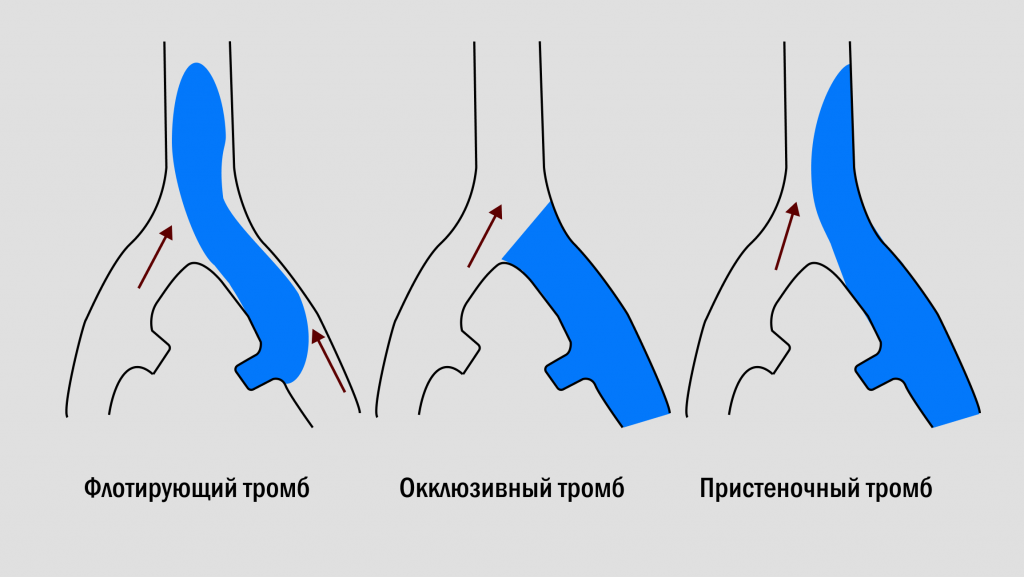 Тромбы в сосудах причины